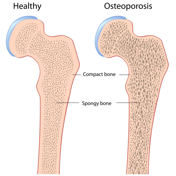 LATHUND – osteoporos